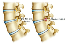 KÉO GIÃN CỘT SỐNG TRONG ĐIỀU TRỊ THOÁT VỊ ĐĨA ĐỆM