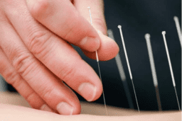 CHÂM CỨU ĐIỀU TRỊ ĐAU THẦN KINH SAU ZONA